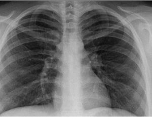 Self Portrait - My Lungs 2015